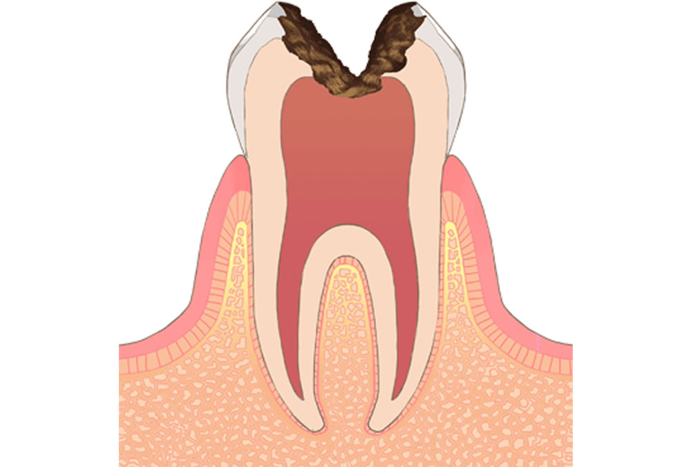 神経まで進行した虫歯