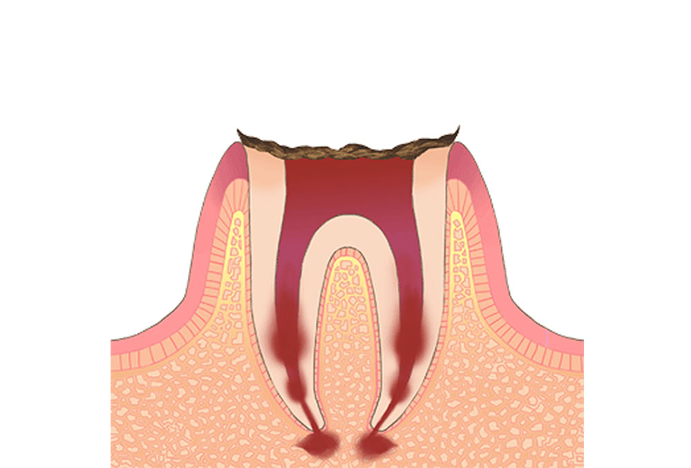 歯根だけが残存している歯の虫歯